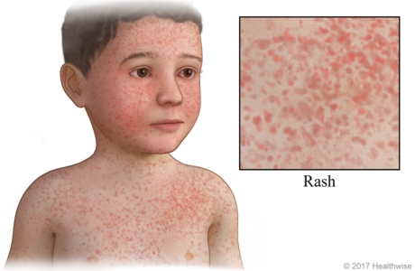 Child with rash caused by rubella on face, neck, and chest, with close-up of rash