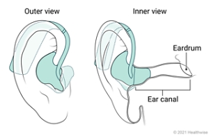 Outer and inner view of behind-the-ear hearing aid placed in ear.