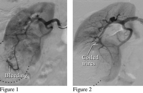 Angiogram image of a renal mass