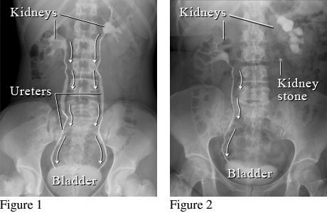 Kidney stone as seen on an intravenous pyelogram (IVP)