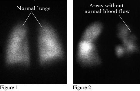 Nuclear medicine scan of lungs