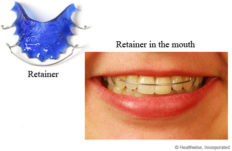 Retainer and photo of retainer in person's mouth