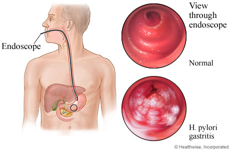 H. pylori gastritis seen through an endoscope