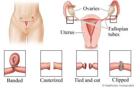 Picture of ligation methods for female sterilization