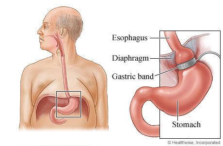 Gastric banding