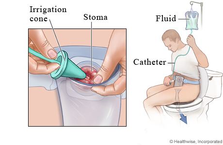 Colostomy irrigation.