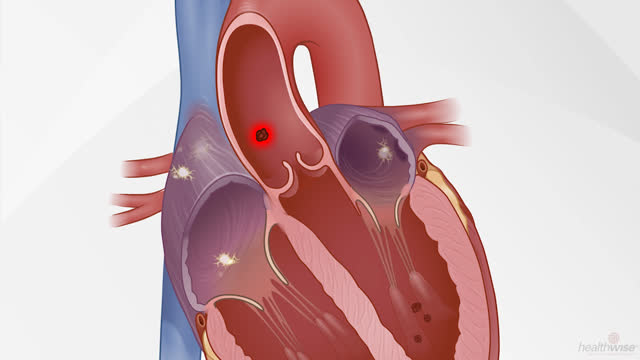 After a Stroke: Taking a Blood Thinner for A-Fib