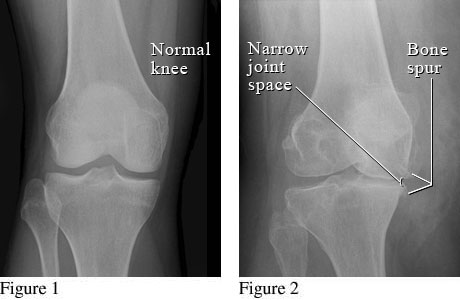 X-ray of osteoarthritis of the knee