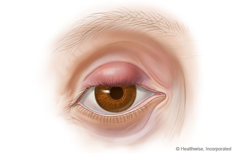 Chalazion