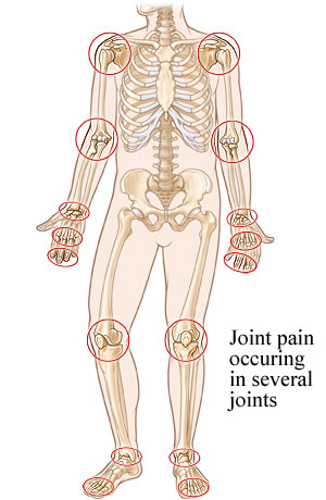 Picture of the common sites for rheumatoid arthritis