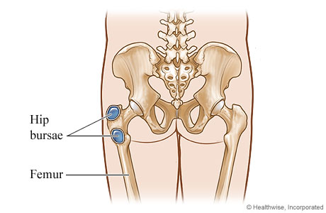 Bursitis of the hip