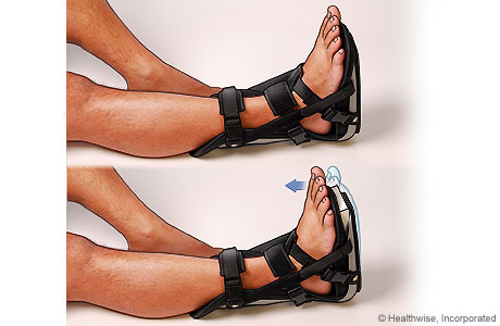 Night brace for Achilles tendon problems