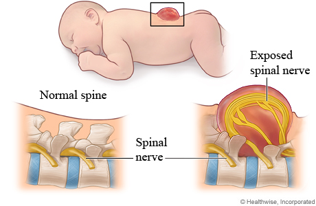 Myelomeningocele (a form of spina bifida)