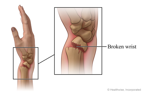 Skeletal view of forearm and hand, with detail of broken wrist