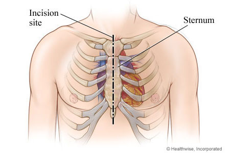 Location of incision in chest Location of incision in chest