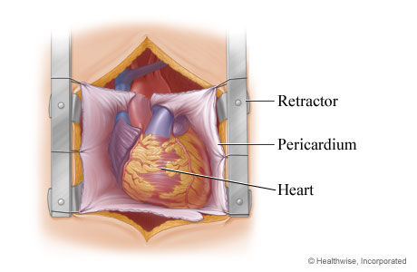 Retractor exposing the heart in the chest Retractor exposing the heart in the chest