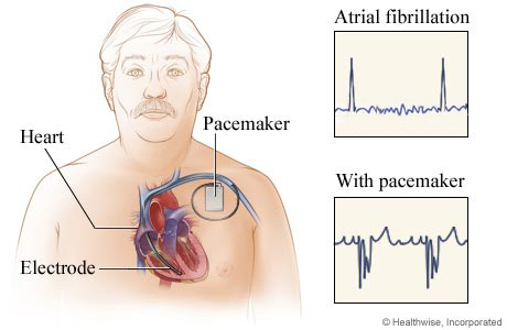 Location of pacemaker in chest, with before-and-after EKG results. Location of pacemaker in chest, with before-and-after EKG results.