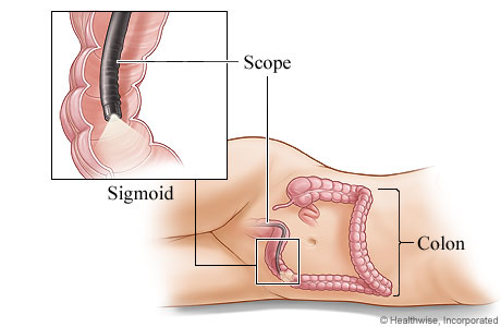 Colonoscope in the colon Colonoscope in the colon