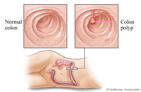 A healthy colon and a colon polyp A healthy colon and a colon polyp