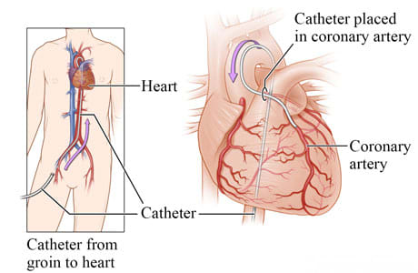 Catheter going from groin to heart, with detail of catheter in a coronary artery.