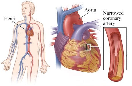 Heart, with detail of coronary artery narrowed by plaque.