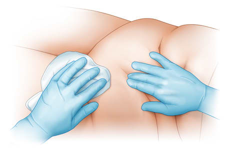 Lift and flatten the skin to wash under skin folds.