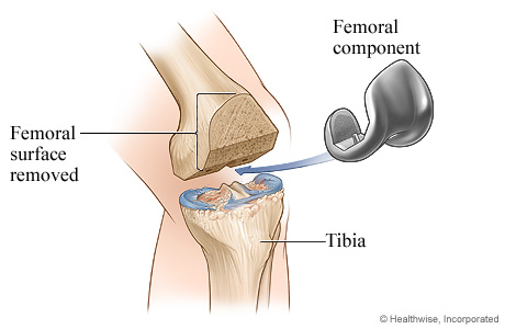 Knee replacement surgery: Femoral component Knee replacement surgery: Femoral component