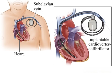 Location of implantable cardioverter-defibrillator and connection to heart chambers