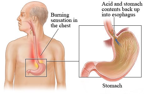 Gastroesophageal reflux disease (GERD).