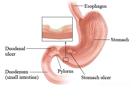 Peptic ulcers in the stomach and duodenum.