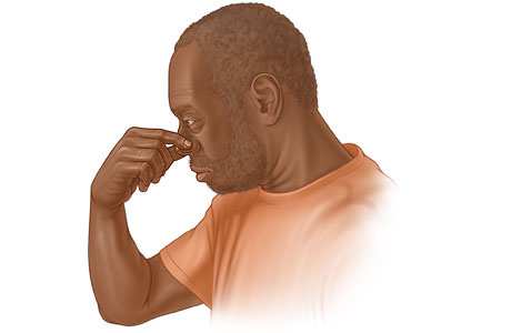 Man pinching nose to stop a nosebleed.